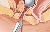 Colpexin insertion medical illustration