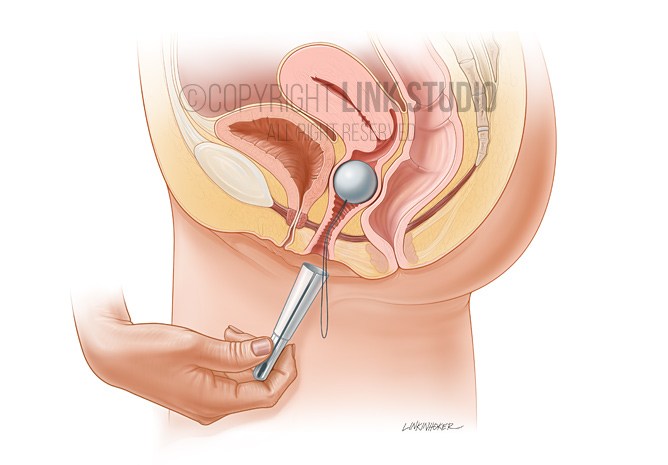 Colpexin insertion medical illustration