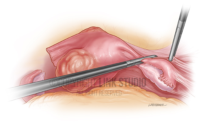 Laparoscopic hysterectomy medical illustration