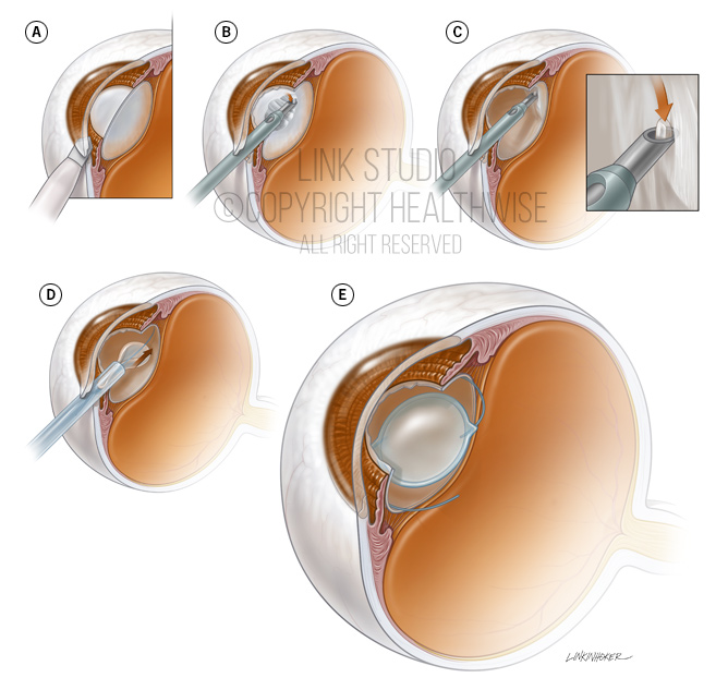 Cataract surgery, phacoemulsification medical illustration