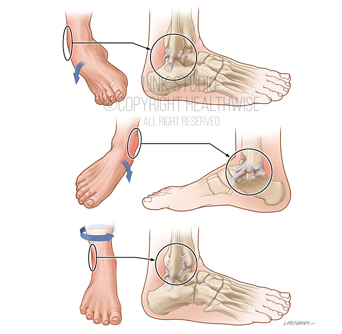 Ankle ligament tears medical illustration