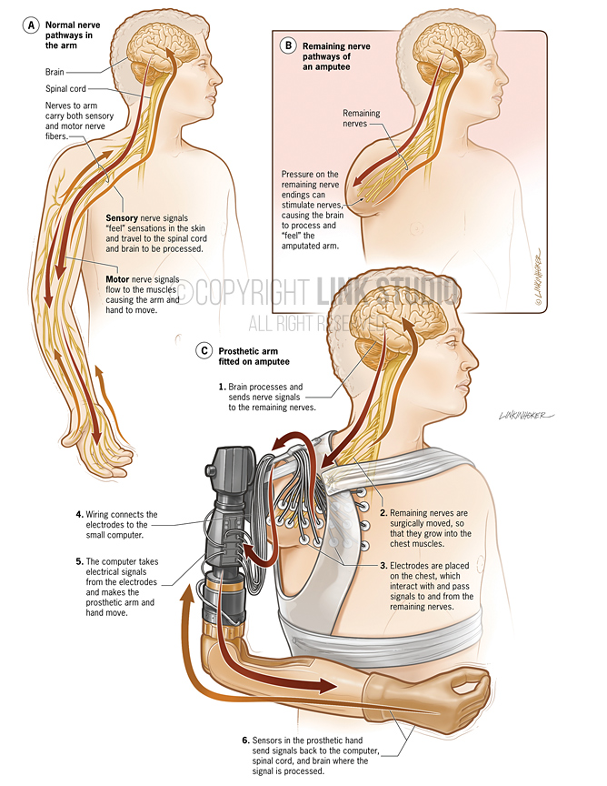 Neural-arm prosthetic medical illustration