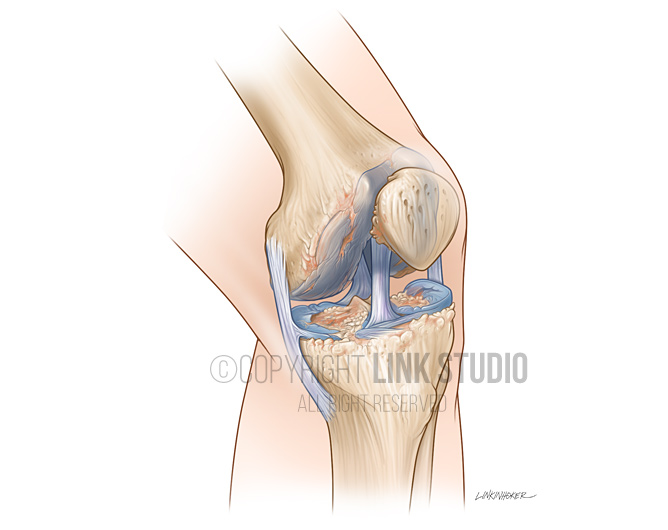 Arthritic knee medical illustration