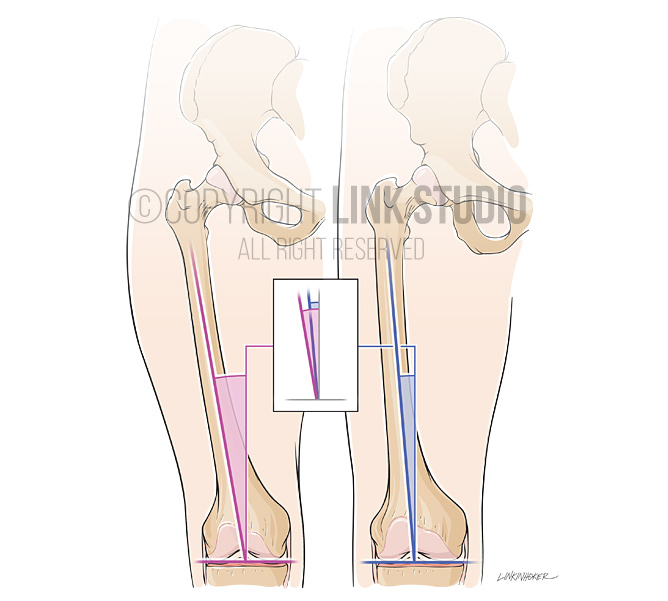 Femoral shaft angle comparison medical illustration