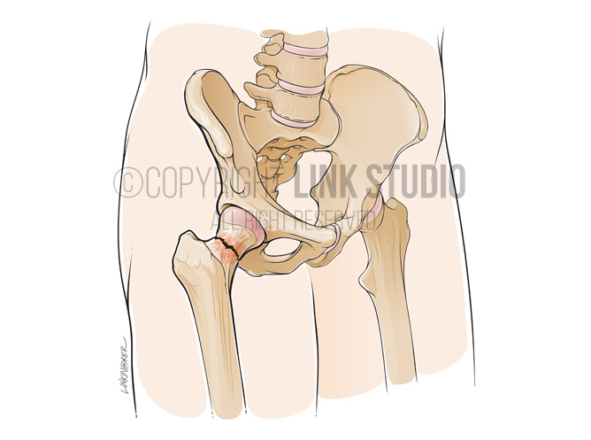 Fractured femoral neck medical illustration
