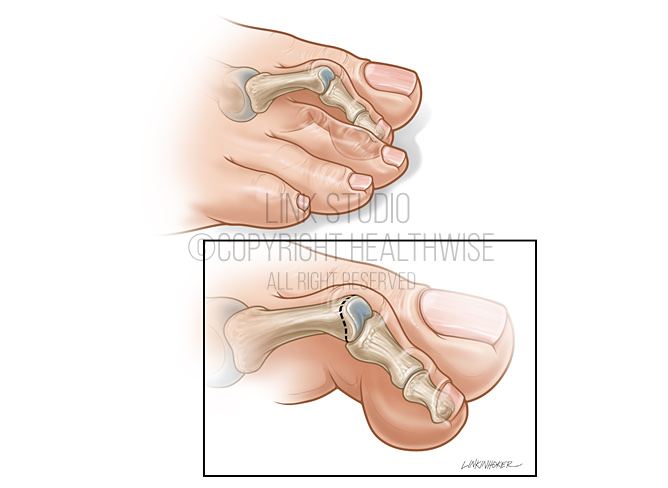 Hammer toe medical illustration