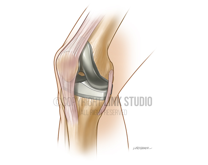 Total knee replacement medical illustration