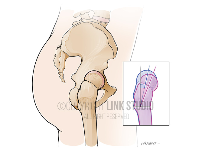 Lateral view of hip medical illustration