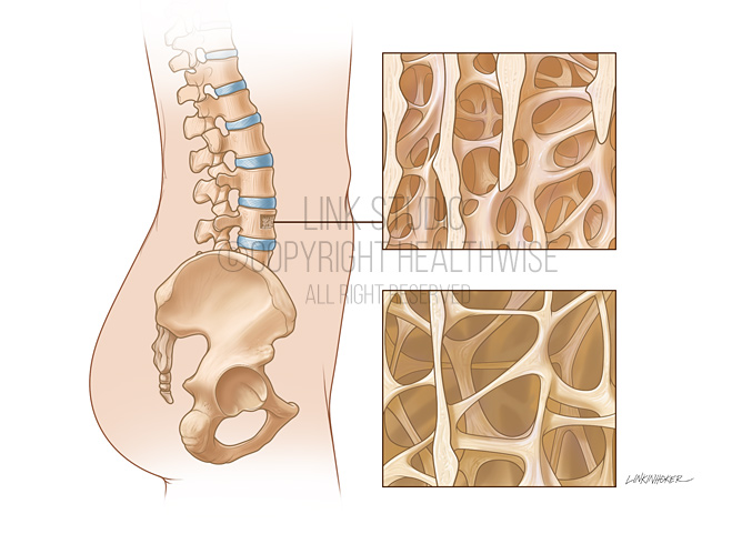 Osteoporosis medical illustration