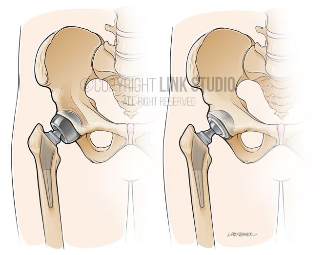 Hip prosthesis medical illustration
