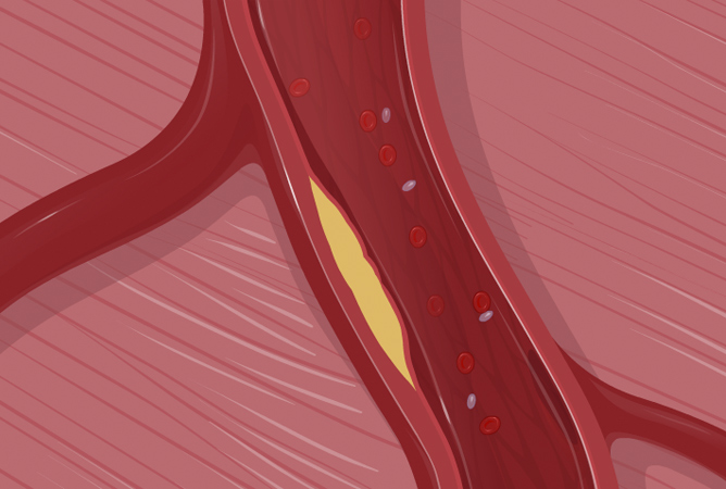 Heart attack medical animation