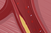 Heart attack medical animation