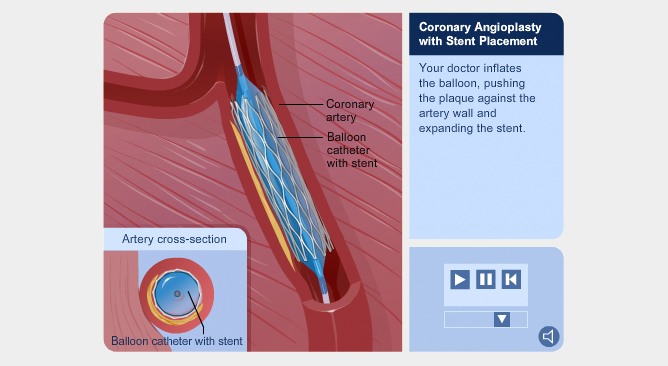 Heart & Coronary Artery Diseases - Link Studio - Medical Animation