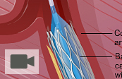 Coronary angioplasty stent placement medical animation