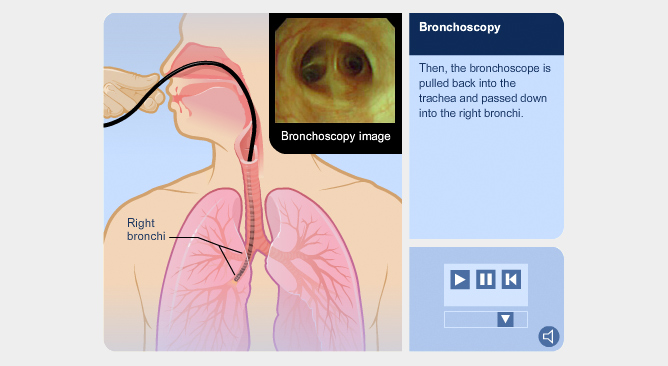 Bronchoscopy medical animation