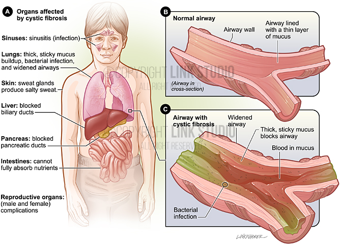 Organs Affected by Cystic Fibrosis Medical Illustration