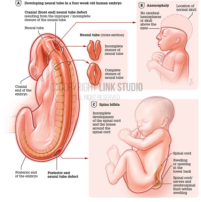 Neural tube defects in an 4 week old embryo