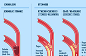 Graphic Anatomy - Cardiovascular Disease