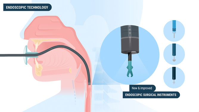 Endoscopic Diverticulotomy Video - endoscopy instruments