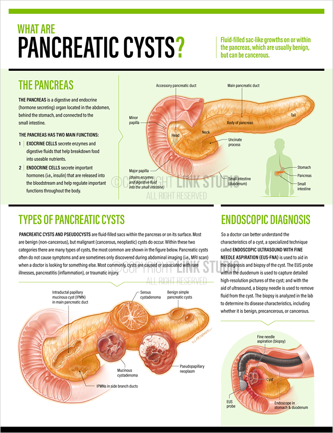 Types Of Pancreatic Cysts